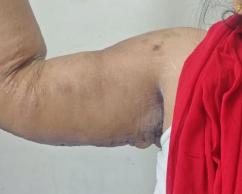 Arm Liposuction after result patient 2