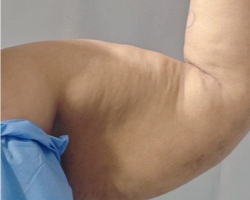 Arm Liposuction before result patient 1