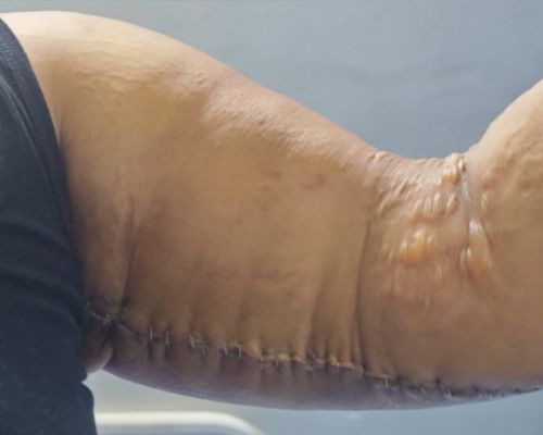 Arm Liposuction after result patient 1