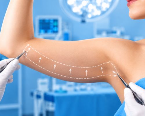 Arm Liposuction treatment planning