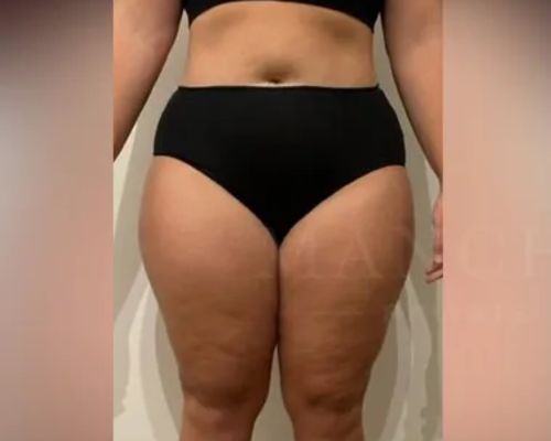 Thigh Liposuction before result patient 1