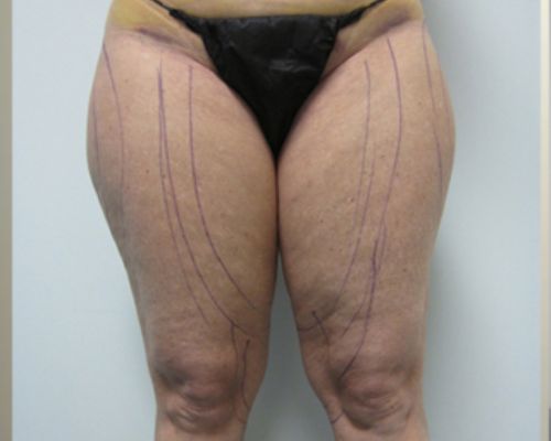 Thigh Liposuction before result patient 2