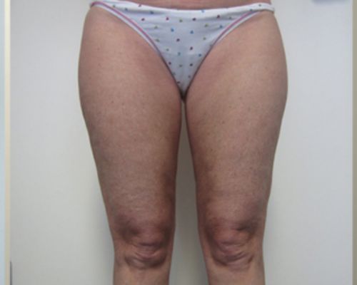 Thigh Liposuction after result patient 2