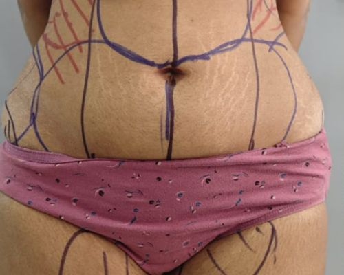 360° Liposuction before result patient 1