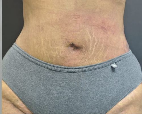 360° Liposuction after result patient 1