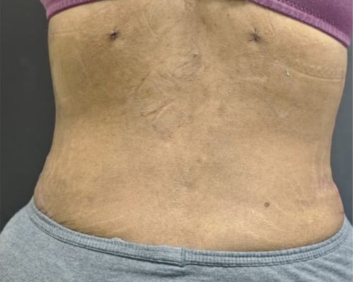 360° Liposuction after result patient 2