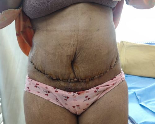 Mommy Makeover after result patient 1