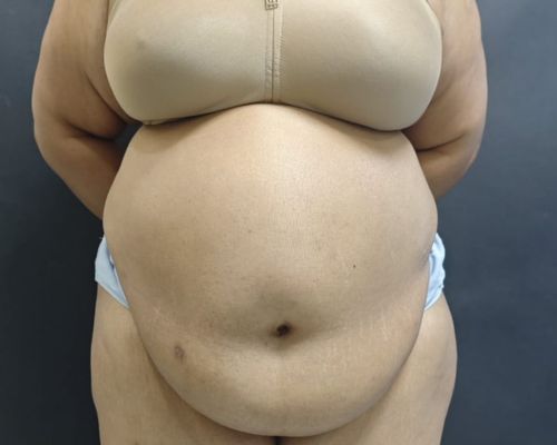 Mommy Makeover before result patient 2
