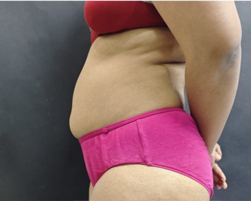 Combined Body Contouring before result patient 1