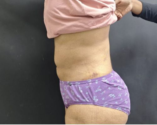 Combined Body Contouring after result patient 1