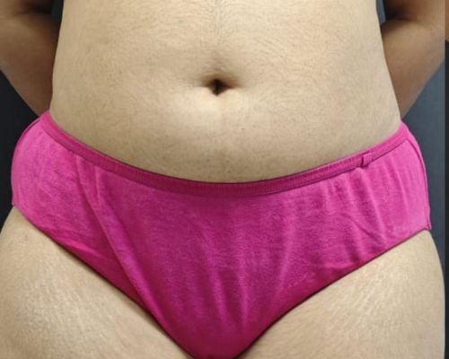 Combined Body Contouring before result patient 2