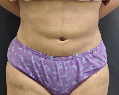 Combined Body Contouring after result patient 2
