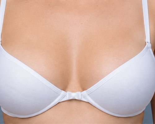 Breast Augmentation before result patient 1