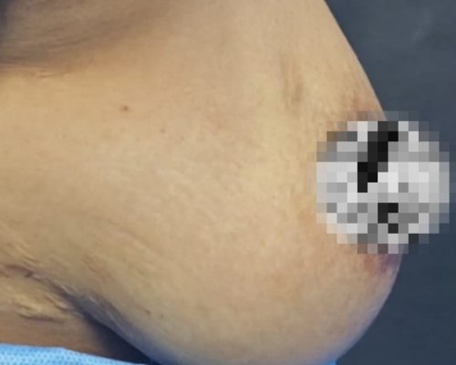 Breast lift before result patient 2