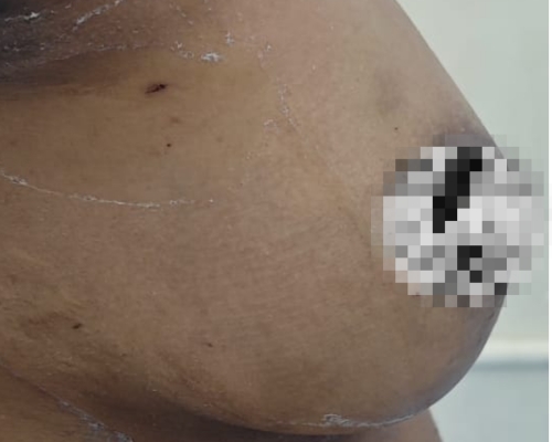 Breast lift after result patient 2