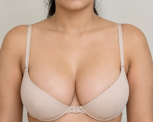 Breast implant revision after result patient 2