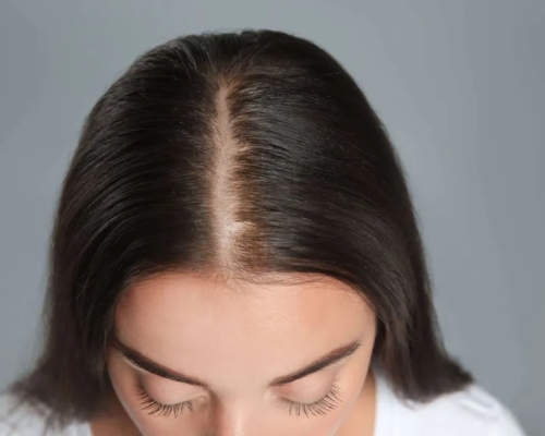 PRP hair treatment before result patient 2