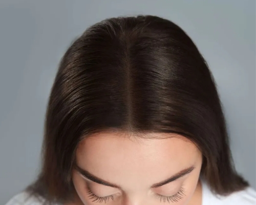 PRP hair treatment after result patient 2