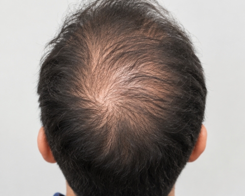 GFC Hair Treatment before result patient 1