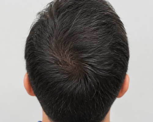 GFC Hair Treatment after result patient 1