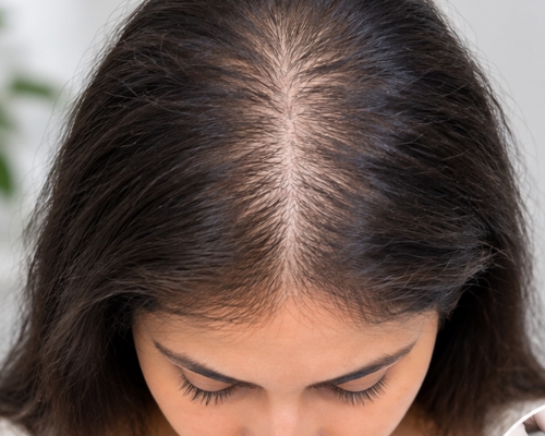 GFC Hair Treatment before result patient 2