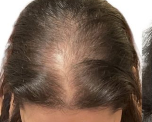 Exosome Hair Therapy before treatment patient 1