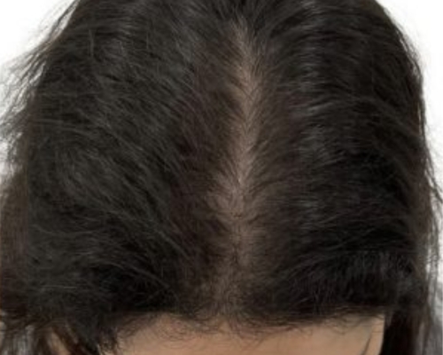 Exosome Hair Therapy after treatment patient 1