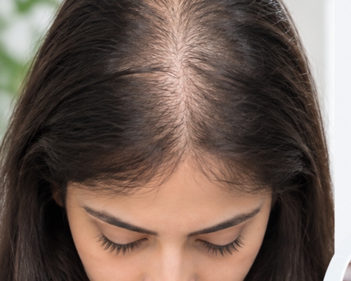 Exosome Hair Therapy before treatment patient 2