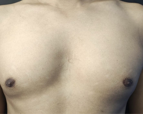 Gynecomastia before result patient 2