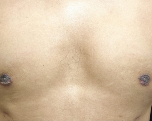 Gynecomastia after result patient 2