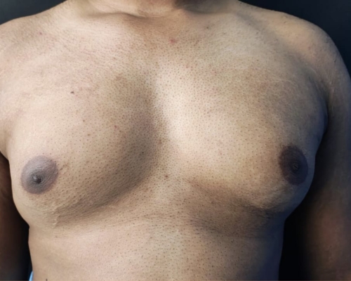 Gynecomastia before result patient 1