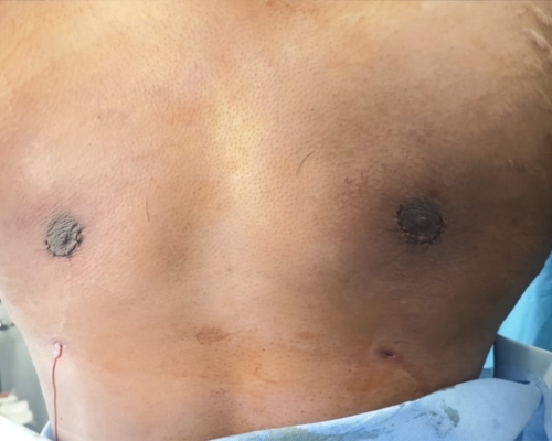 Gynecomastia after result patient 1