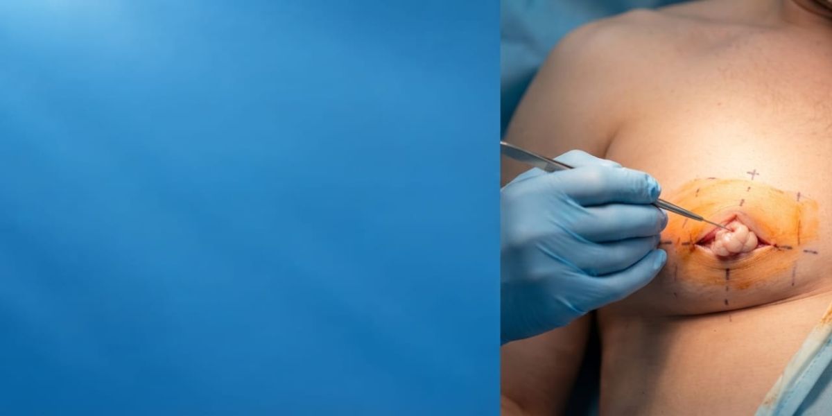 Gynecomastia Surgery