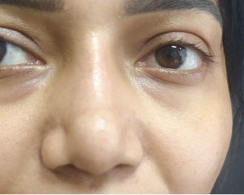 Rhinoplasty before result patient 1