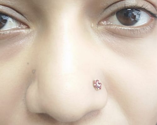 Rhinoplasty after result patient 1