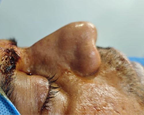 Rhinoplasty before result patient 2