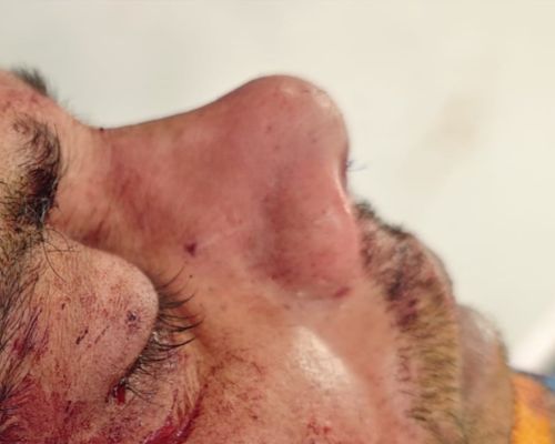 Rhinoplasty after result patient 2
