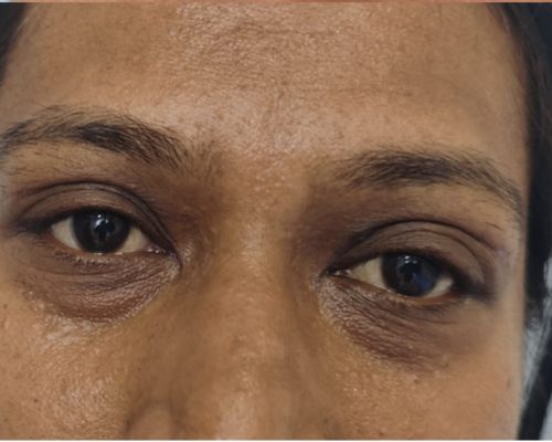 Brow lift before result patient 2