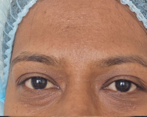 Brow lift after result patient 2