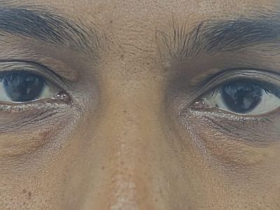 Blepharoplasty before result patient 2