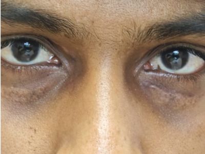 Blepharoplasty after result patient 2