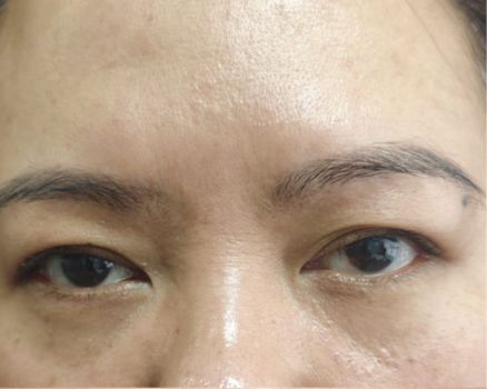 Brow lift after result patient 1