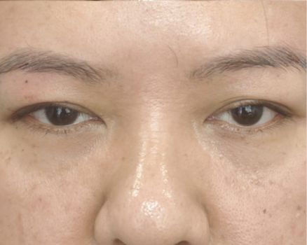 Brow lift before result patient 1
