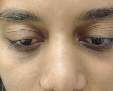 Blepharoplasty before result patient 1