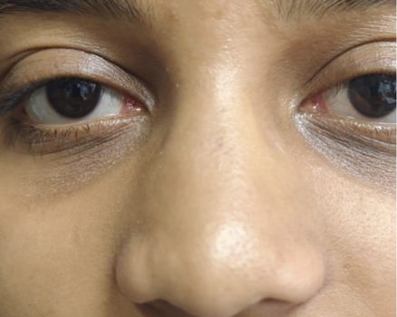 Blepharoplasty after result patient 1