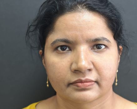 Face lift before result patient 1