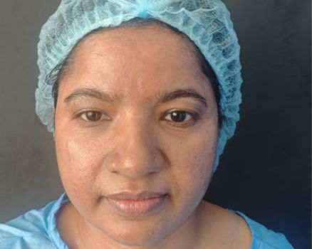 Face lift after result patient 1