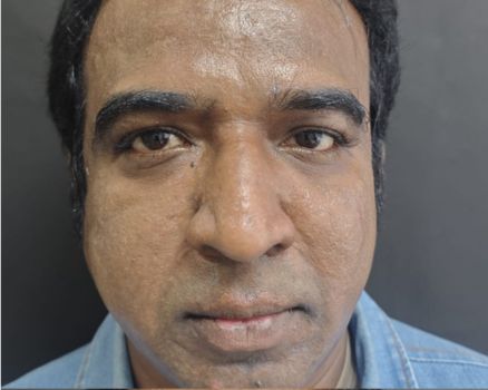 Face lift after result patient 2