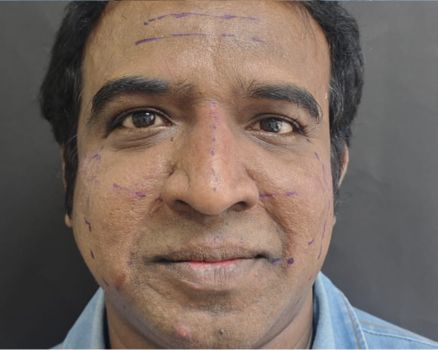 Face lift before result patient 2
