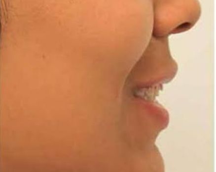 Dimple creation before result patient 2